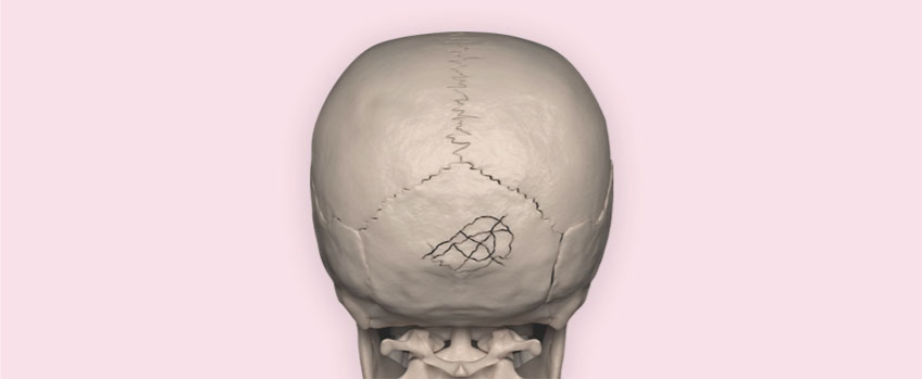 Cranial (Skull) Fractures 