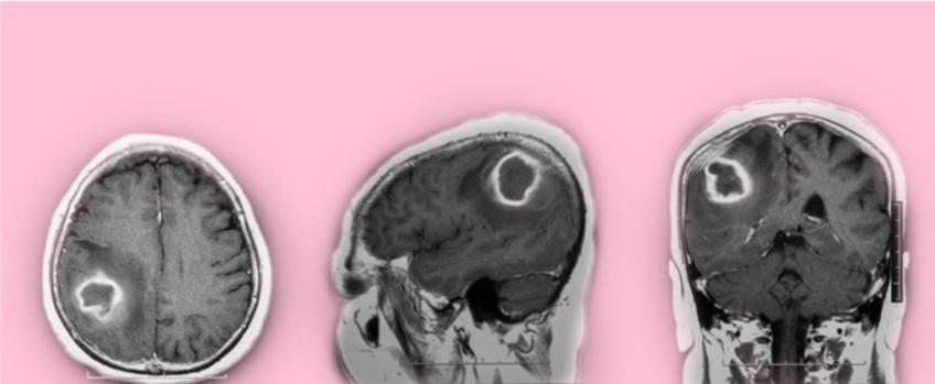 Epilepsy Caused by Tumors or Malformations of Blood Vessels