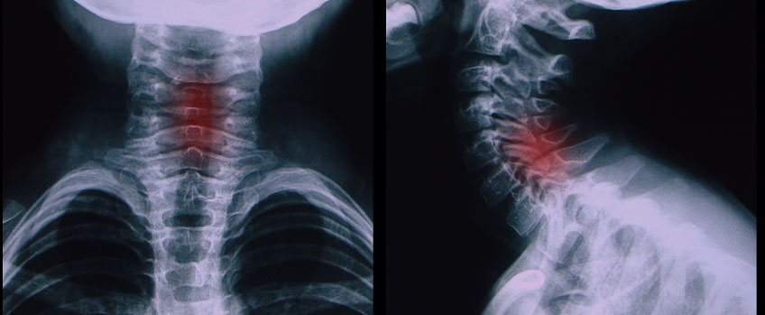 Paediatric Fractures