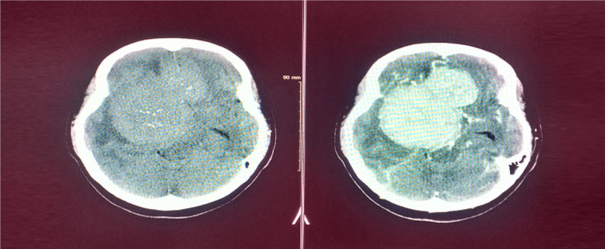 What is a skull base tumor?