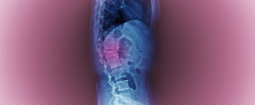 Vertebral Compression Fractures