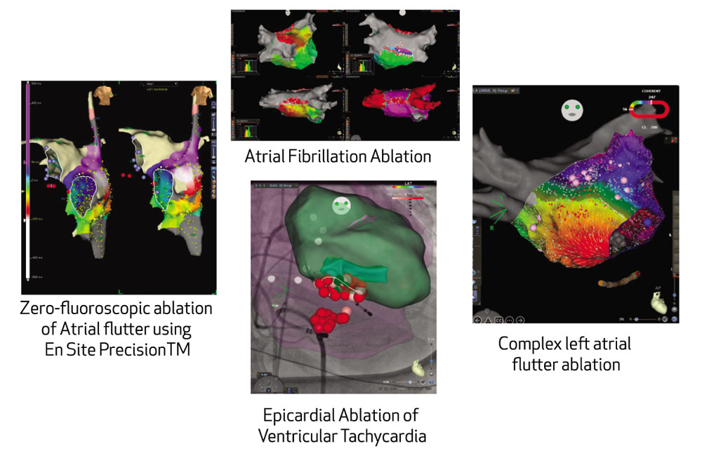 3 dimensional electroanatomical mapping systems