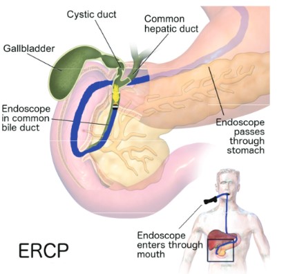 ercp