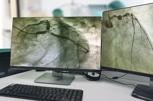 coronary angiogram