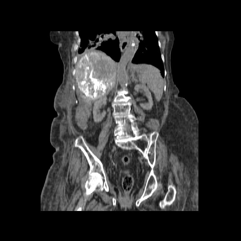 Post-treatment CT showing selective uptake of the agent within the tumor