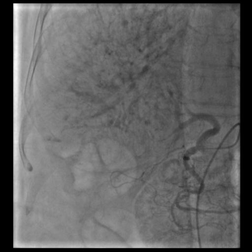 Hepatic Angiogram showing tumor vascularity
