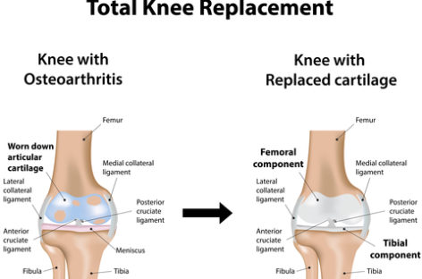 What to Expect from Knee Replacement?