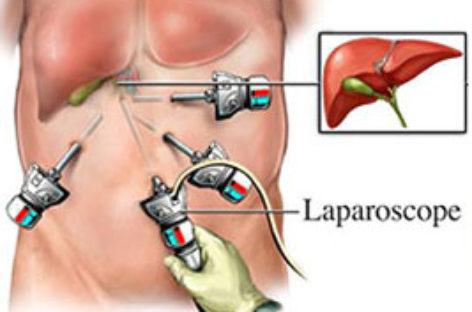 Removal of Gallbladder by Laparoscopy