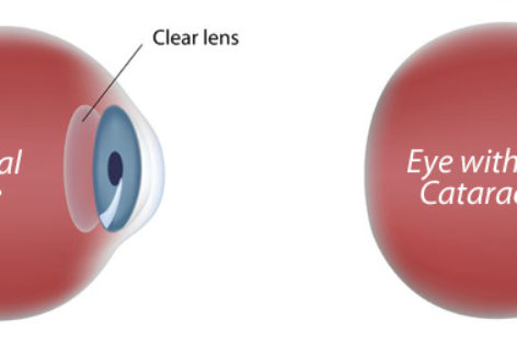 Things You Need to Know about Cataract Surgery
