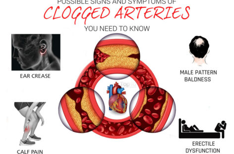 4 Silent Signals for Clogged Arteries