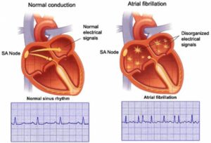 Know About Cardiac Arrhythmia – Irregular Heartbeat