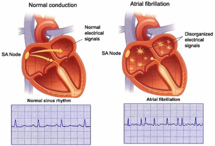 Know About Cardiac Arrhythmia Irregular Heartbeat Kauvery Hospital