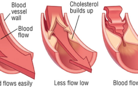 Causes of Blood Flow Obstruction in your body
