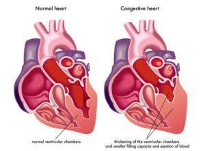 The different stages of Heart Failure | Kauvery Hospital