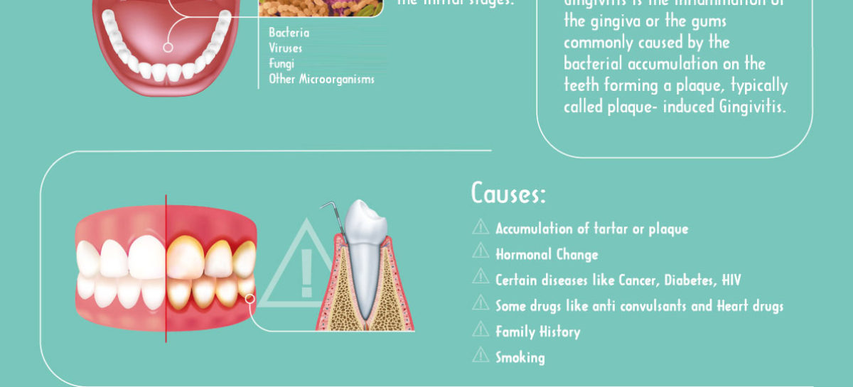 What is Gingivitis? – Infographic