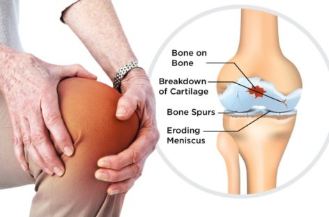 Causes, Symptoms and Treatment of Osteoarthritis