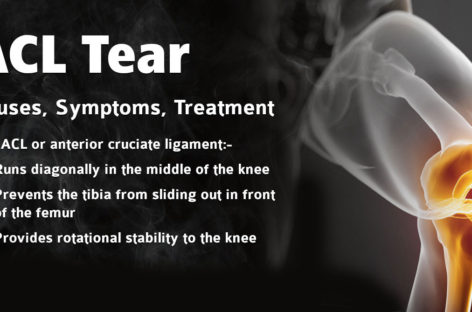 ACL tear – Causes, Symptoms, Treatment