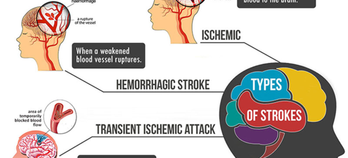 Types of Strokes