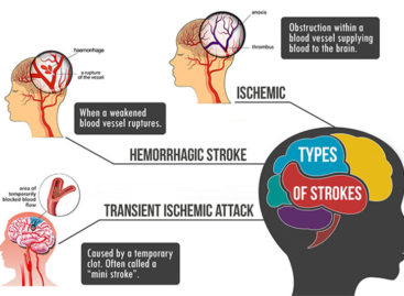 Types of Strokes