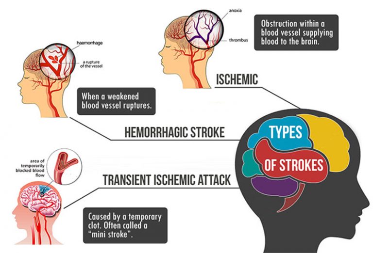 Types of Strokes | Kauvery Hospital