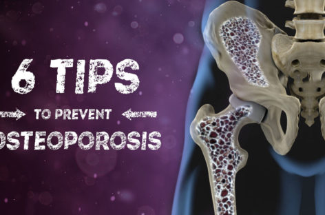 6 Tips to Prevent Osteoporosis