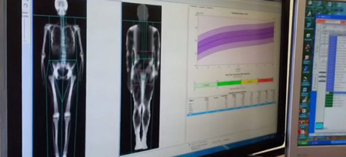 What is a Dexa Scan and how is it done?