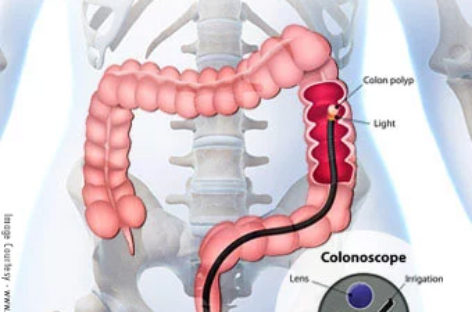 What is a Colonoscopy? Why is it done?