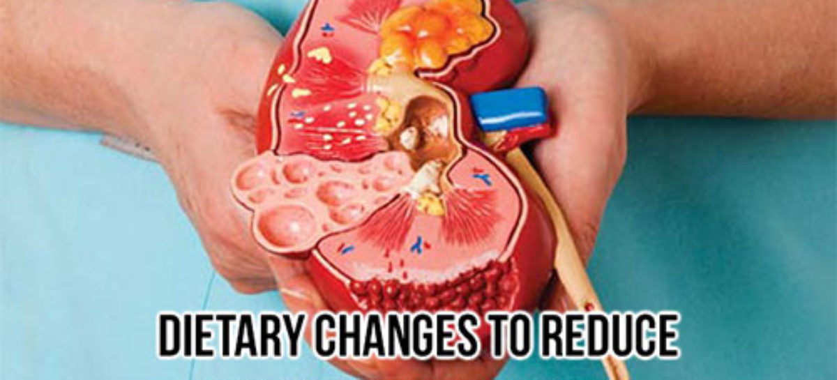 Dietary changes to reduce risk of kidney stones