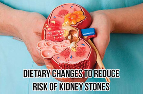 Dietary changes to reduce risk of kidney stones