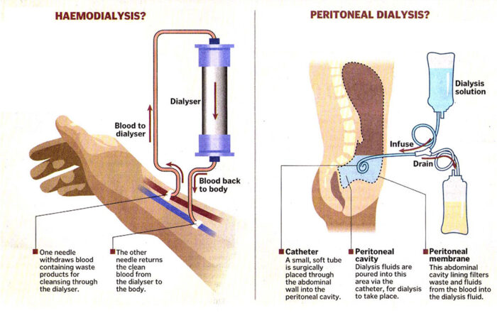 What Is The Procedure For Dialysis 