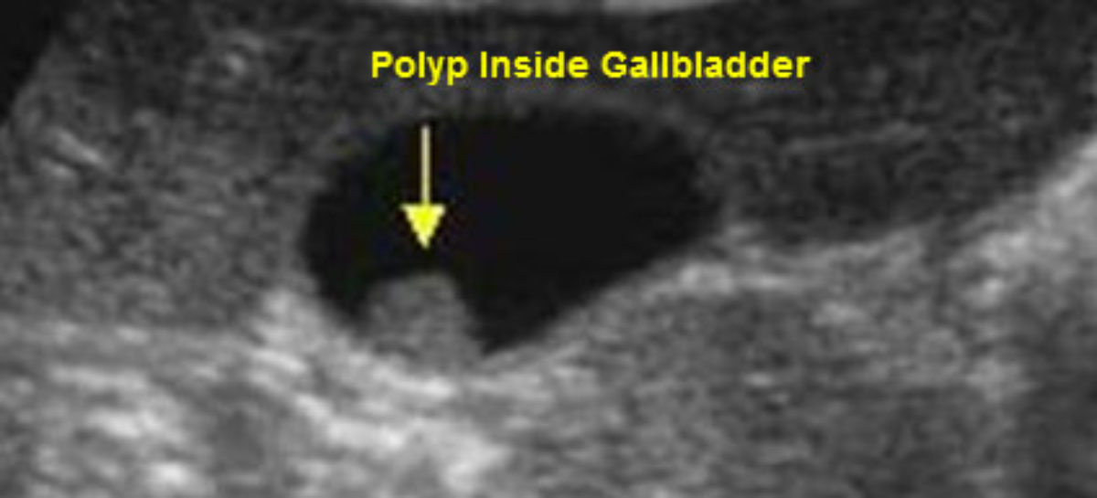 Gallbladder polyps – Symptoms, Diagnosis and Risks