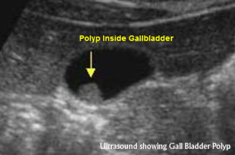 Gallbladder polyps – Symptoms, Diagnosis and Risks