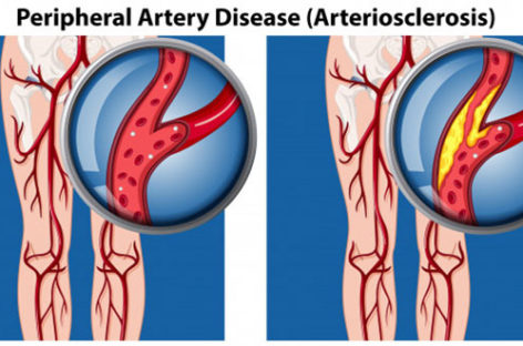 Symptoms and Treatment of Peripheral Artery Disease