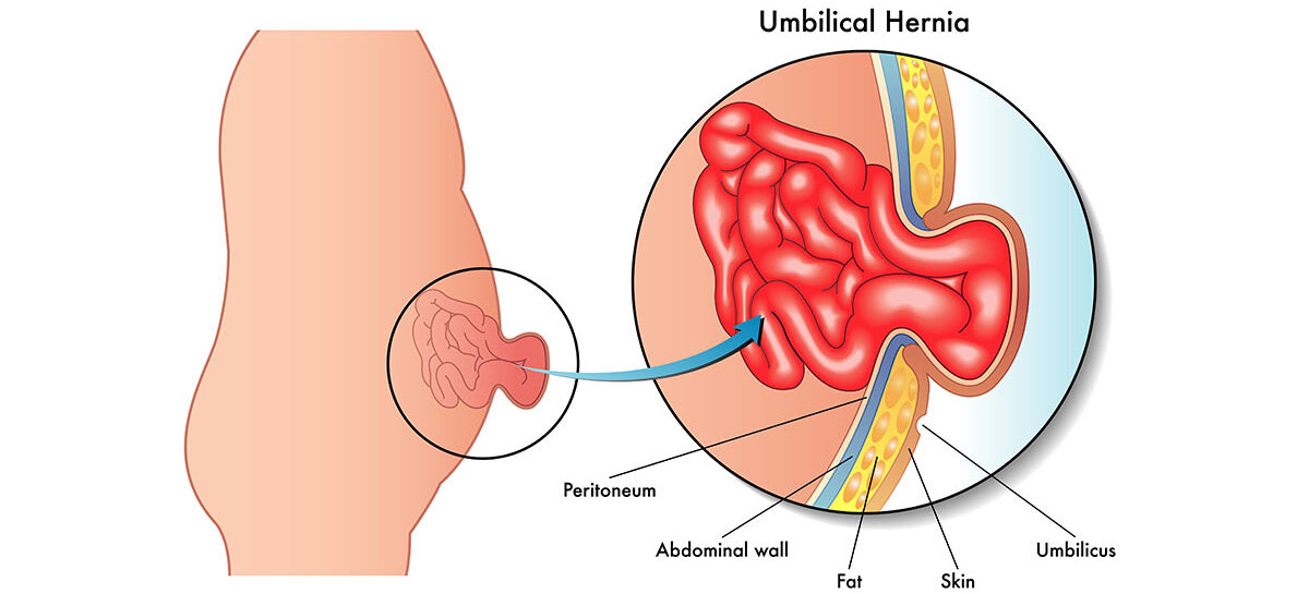 Bulge in your navel? Could be Umbilical Hernia
