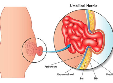 Bulge in your navel? Could be Umbilical Hernia