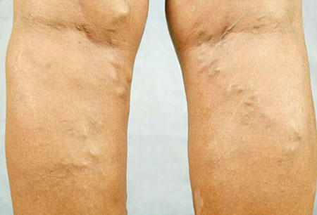 collapsed veins effects