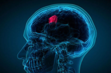 Recognize the warning signs of brain tumour, save a life