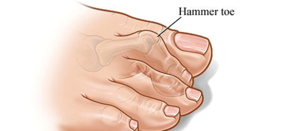 Hammertoe can be life-changing, treat it in time