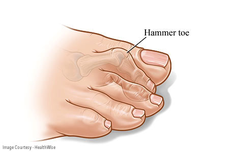 What is a Hammer Toe?, What is the Main Cause of Hammer Toes?