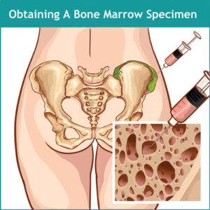 bone marrow specimen