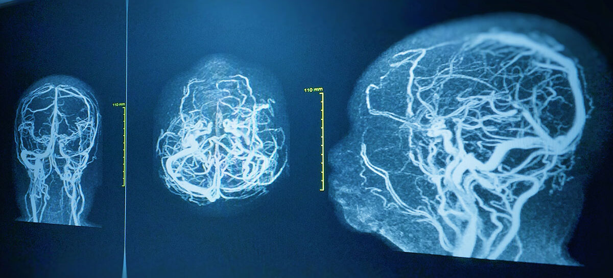 What is a Brain Angiogram and why is it done?