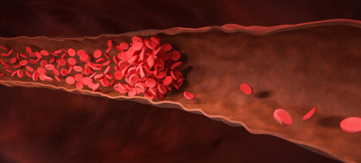 Blood Clots, how they form and common causes