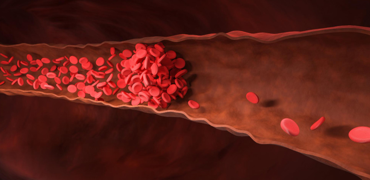 Types and causes of blood clots
