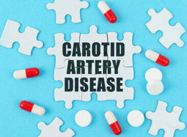 When is Carotid Artery Surgery necessary? What is the success rate?