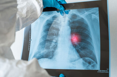 Lung Cancer Screening Tests – when does one need it?