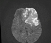 Axial MRI brain