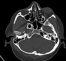 Axial CT brain