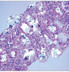 renal biopsy