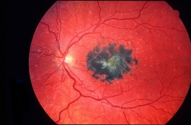 oxalate deposition in the retina