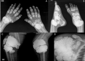 oxalate deposition in bones